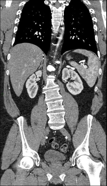 File:Coarctation of the aorta (Radiopaedia 74632-88521 B 153).jpg