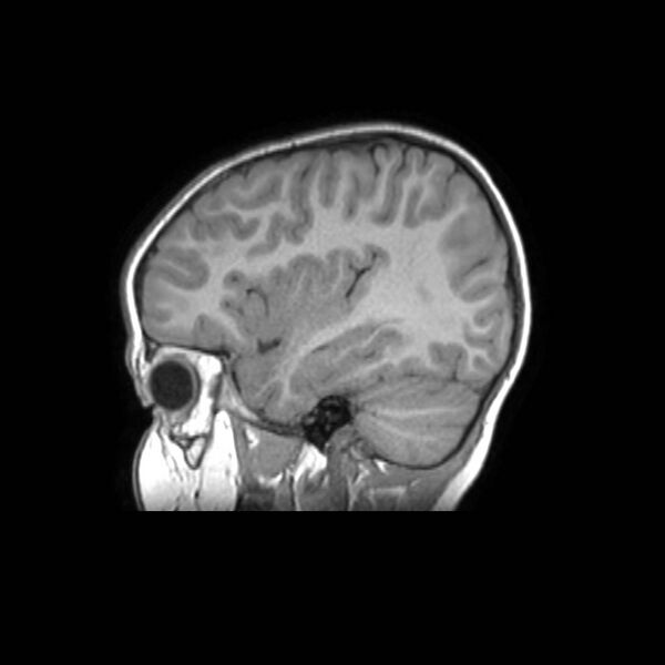 File:Cochlear nerve aplasia - unilateral (Radiopaedia 87910-104413 Sagittal T1 35).jpg