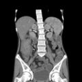 Colocolic fistula - Crohn disease (Radiopaedia 57063-63955 B 25).jpg