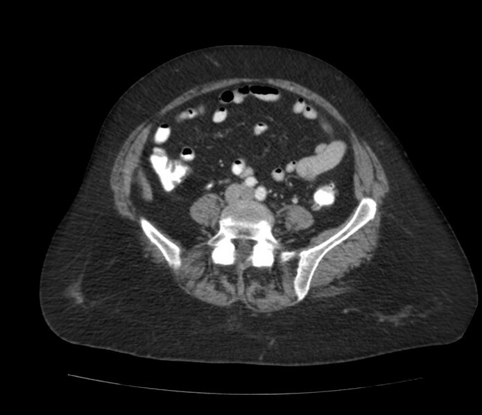 File:Colonic diverticulosis (Radiopaedia 22934-22957 A 48).jpg