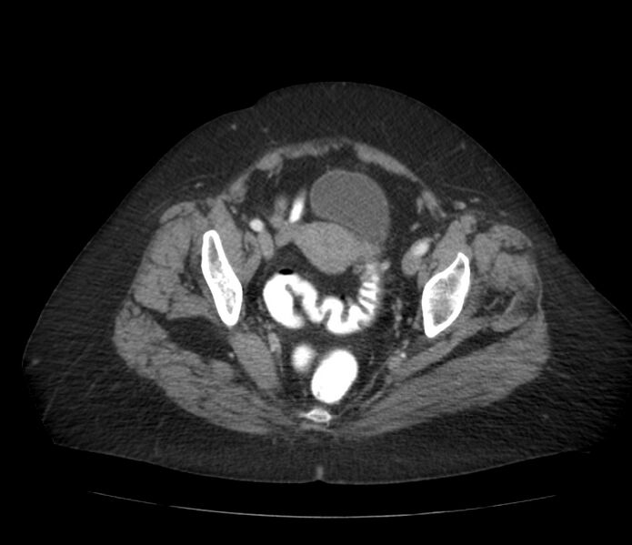 File:Colonic diverticulosis (Radiopaedia 22934-22957 A 64).jpg
