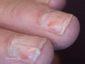 Nail splitting- onychoschizia (DermNet NZ hair-nails-sweat-schizia2).jpg