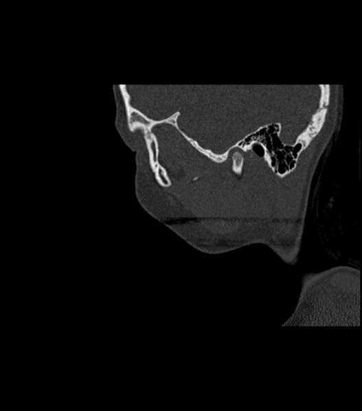 File:Nasoorbitoethmoid fracture (Radiopaedia 90044-107205 Sagittal bone window 119).jpg