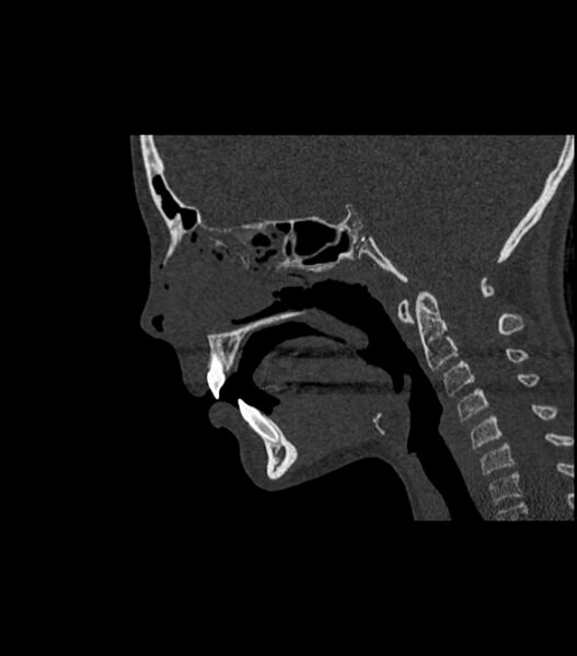 File:Nasoorbitoethmoid fracture (Radiopaedia 90044-107205 Sagittal bone window 72).jpg