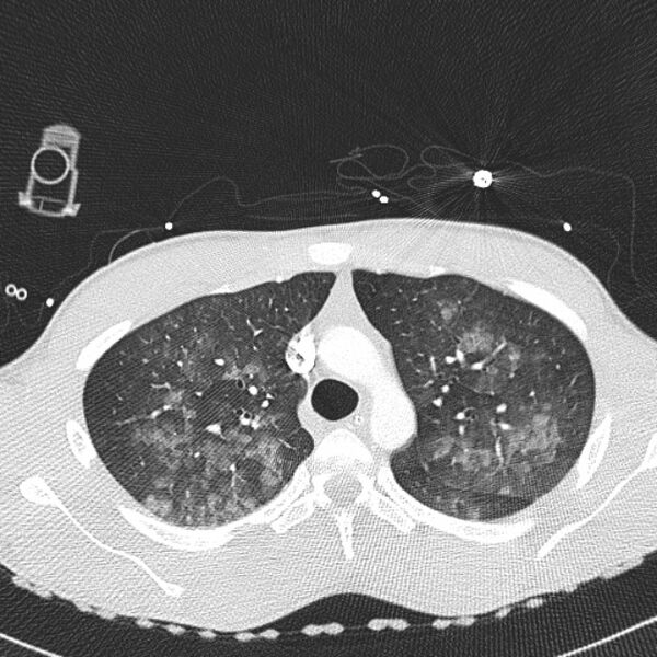 File:Near drowning (pulmonary edema) (Radiopaedia 24685-24958 lung window 1).jpg