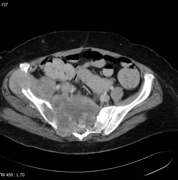 File:Nerve sheath tumor - malignant - sacrum (Radiopaedia 5219-6987 A 7).jpg