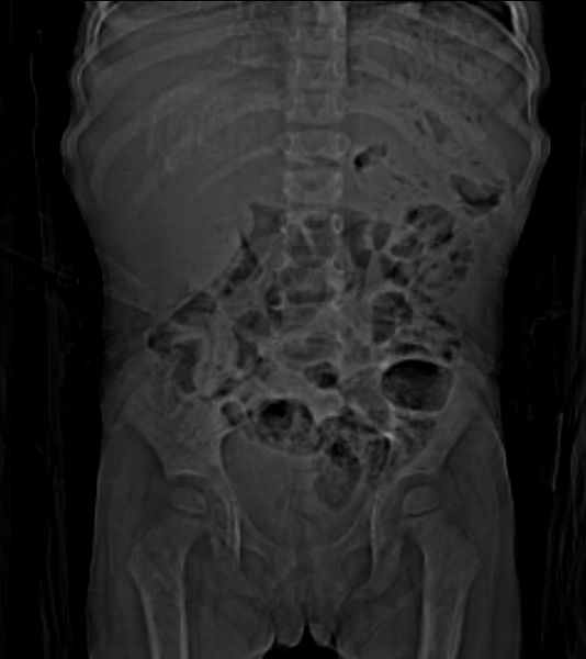 File:Neuroblastoma (Radiopaedia 24751-25016 Coronal CT scout 1).png
