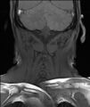 Neurofibromatosis type 1 (Radiopaedia 80355-93740 Coronal T1 11).jpg