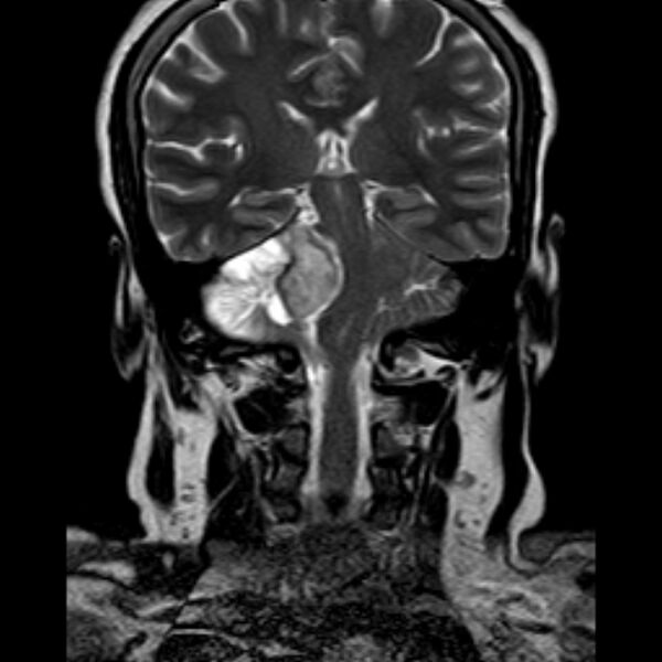 File:Neurofibromatosis type 2 (Radiopaedia 67470-76871 Coronal T2 14).jpg