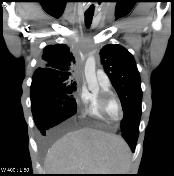 File:Non-Hodgkin lymphoma involving lung (Radiopaedia 29094-29470 C 9).jpg