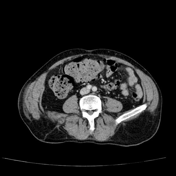 File:Non small-cell lung cancer (Radiopaedia 24467-24769 C+ delayed 86).jpg