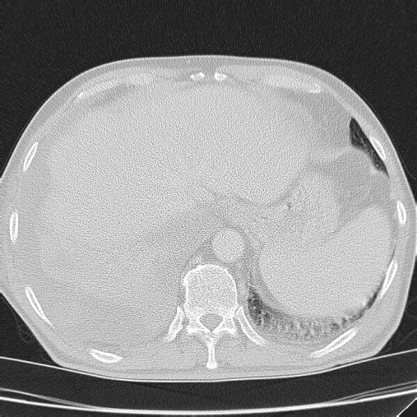 File:Non small-cell lung cancer (Radiopaedia 24467-24769 lung window 46).jpg