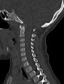Normal CT cervical spine - pediatric (Radiopaedia 52549-58462 Sagittal bone window 121).jpg
