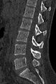 Normal CT lumbar spine (Radiopaedia 53981-60118 Sagittal bone window 46).jpg