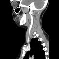 Normal CT of the neck (Radiopaedia 14575-14500 Sagittal C+ 38).jpg