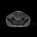 Normal MRI abdomen in pregnancy (Radiopaedia 88001-104541 Axial T2 51).jpg