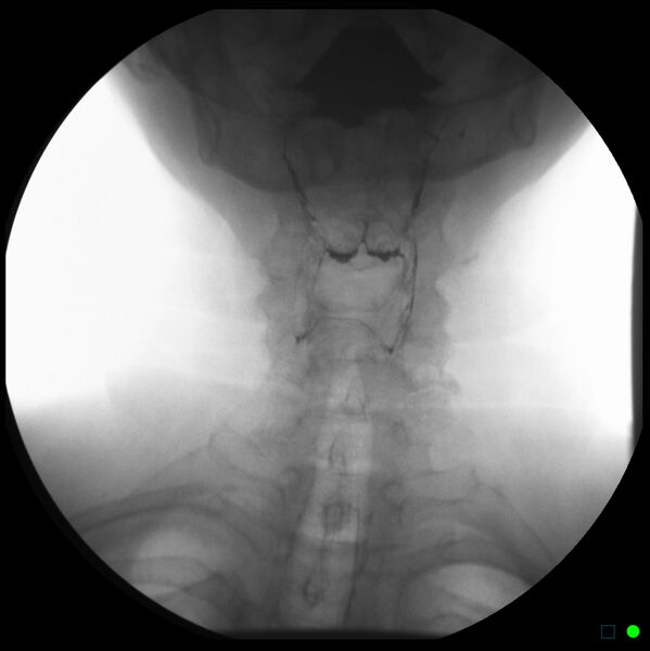 File:Normal barium swallow - AP pharynx (Radiopaedia 8892).jpg
