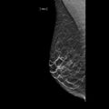Normal breast mammography (tomosynthesis) and ultrasound (Radiopaedia 65325-74353 RMLO C-view 1).jpeg