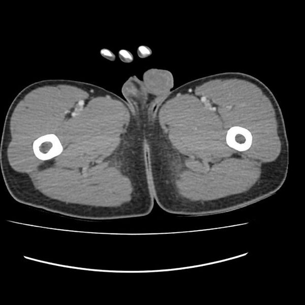 File:Normal dual-phase trauma CT chest,abdomen and pelvis (Radiopaedia 48092-52899 A 126).jpg