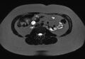 Normal liver MRI with Gadolinium (Radiopaedia 58913-66163 E 4).jpg