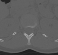 Normal lumbar spine CT (Radiopaedia 46533-50986 Axial bone window 5).png