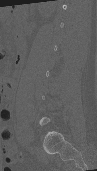 File:Normal lumbar spine CT (Radiopaedia 46533-50986 Sagittal bone window 30).png