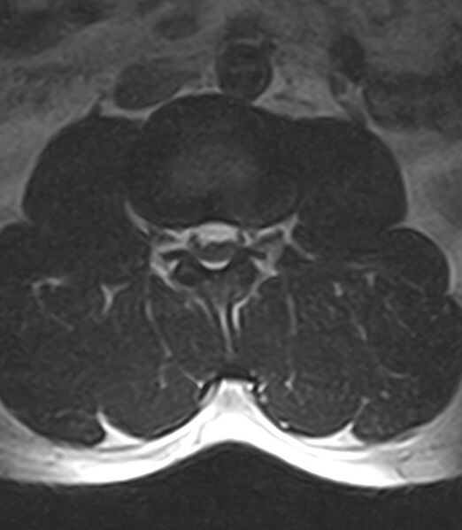 File:Normal lumbar spine MRI - low-field MRI scanner (Radiopaedia 40976-43699 Axial T2 45).jpg