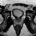 Normal prostate (MRI) (Radiopaedia 29986-30535 Axial T2 10).jpg