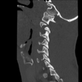 Normal trauma cervical spine (Radiopaedia 41017-43760 Sagittal bone window 9).png