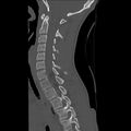 Normal trauma spine imaging (age 16) (Radiopaedia 45335-49358 Sagittal bone window 22).jpg