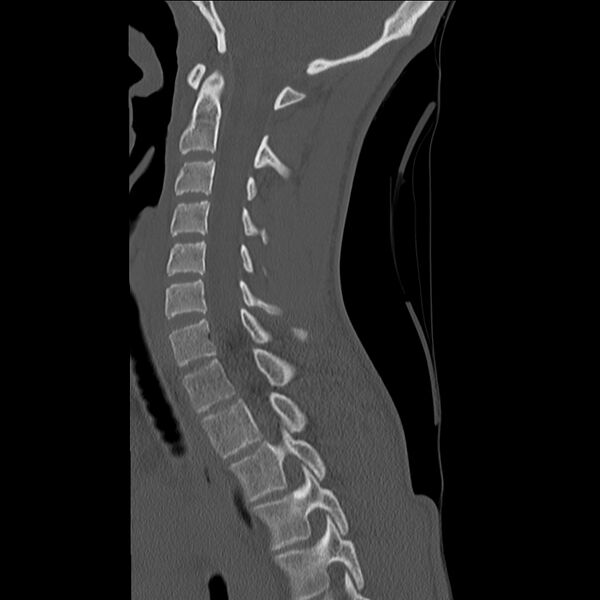 File:Normal trauma spine imaging (age 16) (Radiopaedia 45335-49358 Sagittal bone window 22).jpg