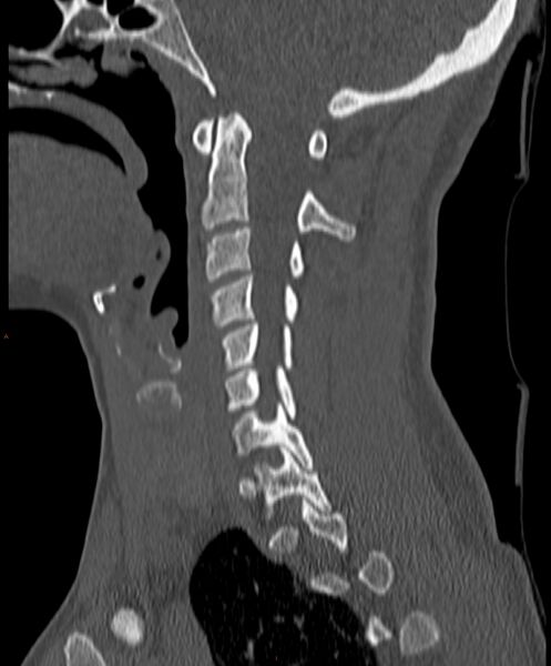 File:Occipital condyle fracture (Radiopaedia 61165-69056 Sagittal bone window 11).jpg