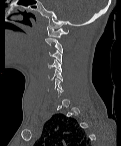 File:Occipital condyle fracture (Radiopaedia 61165-69056 Sagittal bone window 8).jpg