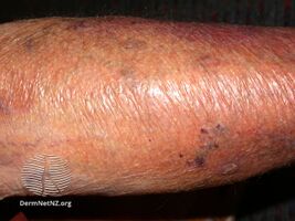 Skin thinning due to topical steroids