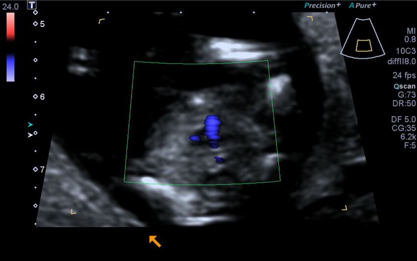 1st trimester nuchal-morphology ultrasound (Radiopaedia 44706-48477 Heart views cine with colour 150).jpg