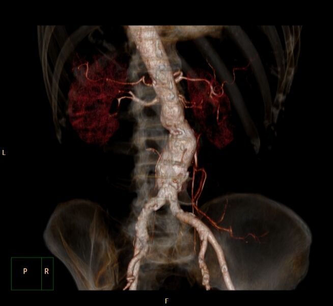 File:Abdominal aortic aneurysm (Radiopaedia 23703-23856 3D 12).jpg