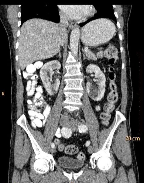 File:Abdominal aortic aneurysm (Radiopaedia 25985-26121 Coronal C+ arterial phase 22).jpg