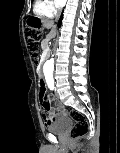 File:Abdominal aortic aneurysm (Radiopaedia 83581-98689 Sagittal C+ arterial phase 41).jpg