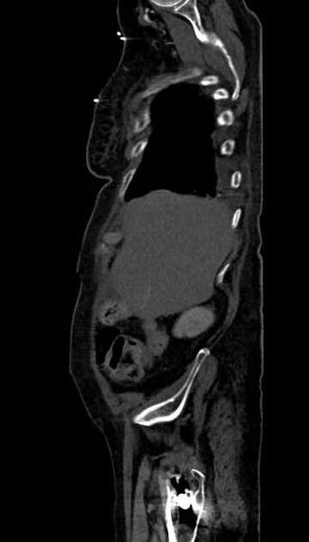 File:Abdominal aortic aneurysm with thrombus fissuration (Radiopaedia 73192-83919 Sagittal C+ arterial phase 123).jpg