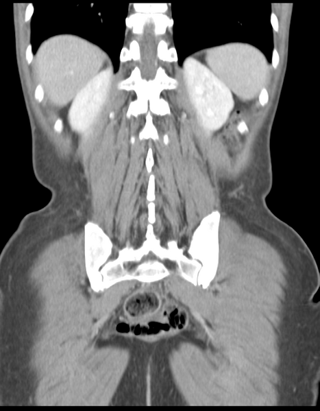 File:Abdominal desmoid tumor (Radiopaedia 41007-43740 Coronal C+ portal venous phase 33).png
