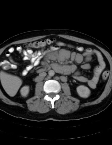 File:Abdominal lymphoma - with sandwich sign (Radiopaedia 53486-59492 Axial C+ portal venous phase 25).jpg