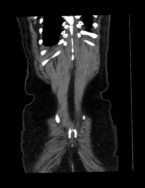 File:Abdominal lymphoma - with sandwich sign (Radiopaedia 53486-59492 C+ portal venous phase 4).jpg