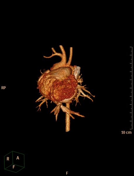 File:Aberrant left pulmonary artery (pulmonary sling) (Radiopaedia 42323-45435 3D reconstruction C+ CTPA 1).jpg