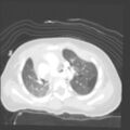 Aberrant left pulmonary artery (pulmonary sling) (Radiopaedia 42323-45435 Axial lung window 13).jpg