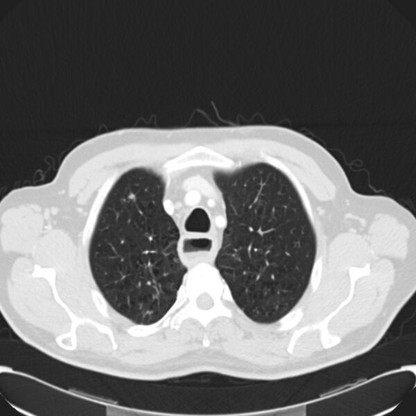 File:Achalasia (Radiopaedia 24937-25206 Axial lung window 6).jpg