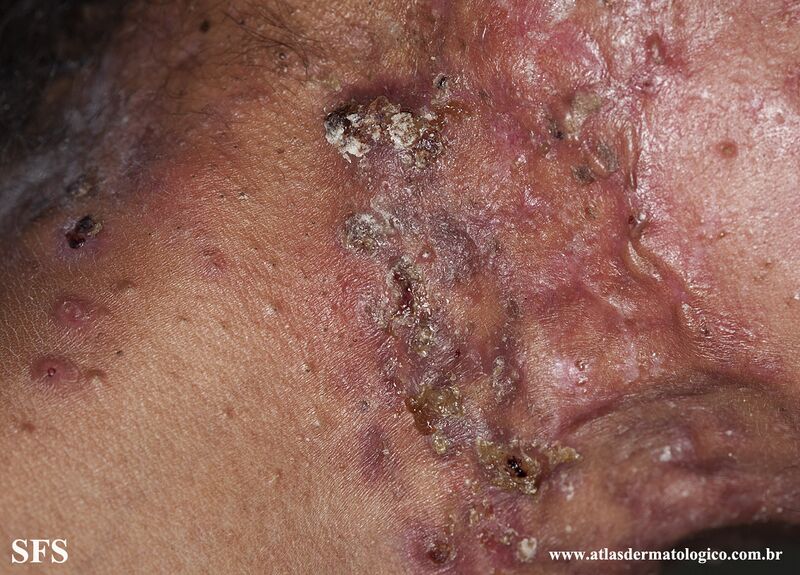 File:Acne Fulminans (Dermatology Atlas 14).jpg