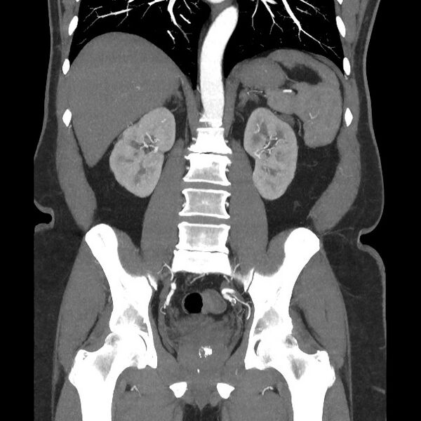 File:Active colonic bleed on CT (Radiopaedia 49765-55025 Coronal art MIP 40).jpg
