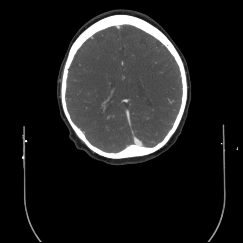 Acute M1 occlusion with ischemic penumbra (CT perfusion) (Radiopaedia 71897-82344 Axial C+ arterial phase thins 21).jpg