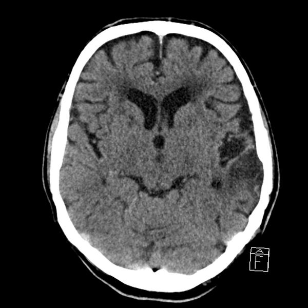 File:Acute P1 occlusion with PCA ischemia penumbra (CT perfusion) (Radiopaedia 72084-82586 Axial non-contrast 18).jpg