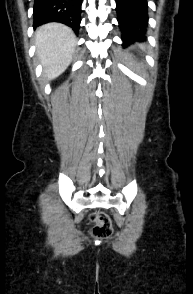 File:Acute appendicitis (Radiopaedia 22892-22918 Coronal C+ portal venous phase 51).png